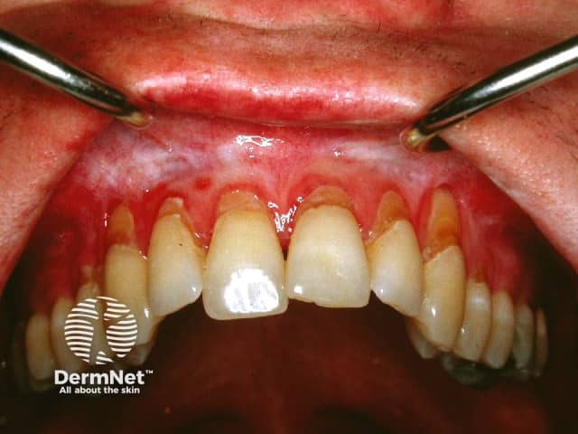 Graft versus host disease